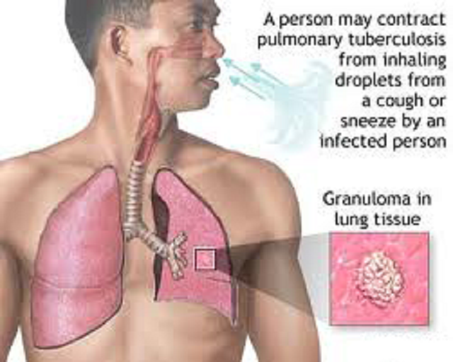 tuberculosis-signs-symptoms-treatment-and-prevention-the-sunday-news